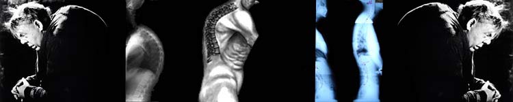 Hunch back posture problems