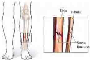 Stress Fractures