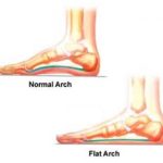 Overpronation Foot Problems: How to Fix Flat Feet