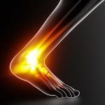 Identifying Achilles Pain and What to Do About It Identifying Achilles Pain and What to Do About It