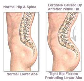 Anterior Pelvic Tilt: What is It and How Can You Fix It?