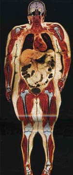 Dxa Scan for Lean Body Mass