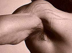 stretch marks from building muscle too fast
