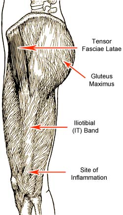 IT Band Friction Syndrome: A Common Cause of Knee Pain for Runners and Cyclists