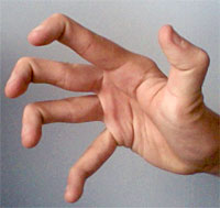 hypermobility in hand