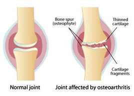 joint effected by osteoarthritis