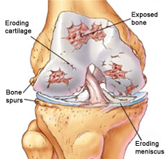 osteoarthritis joint diagram