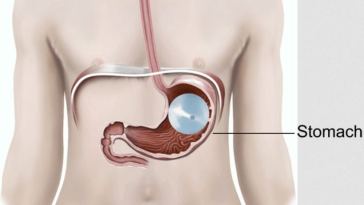 gastric balloon