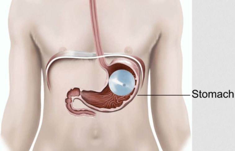 gastric balloon