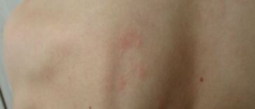 rash