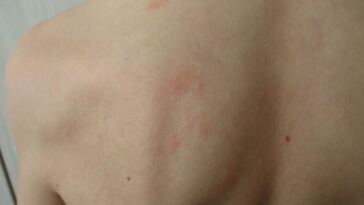 rash