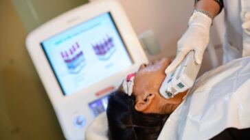 laser hair removal