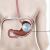 gastric balloon